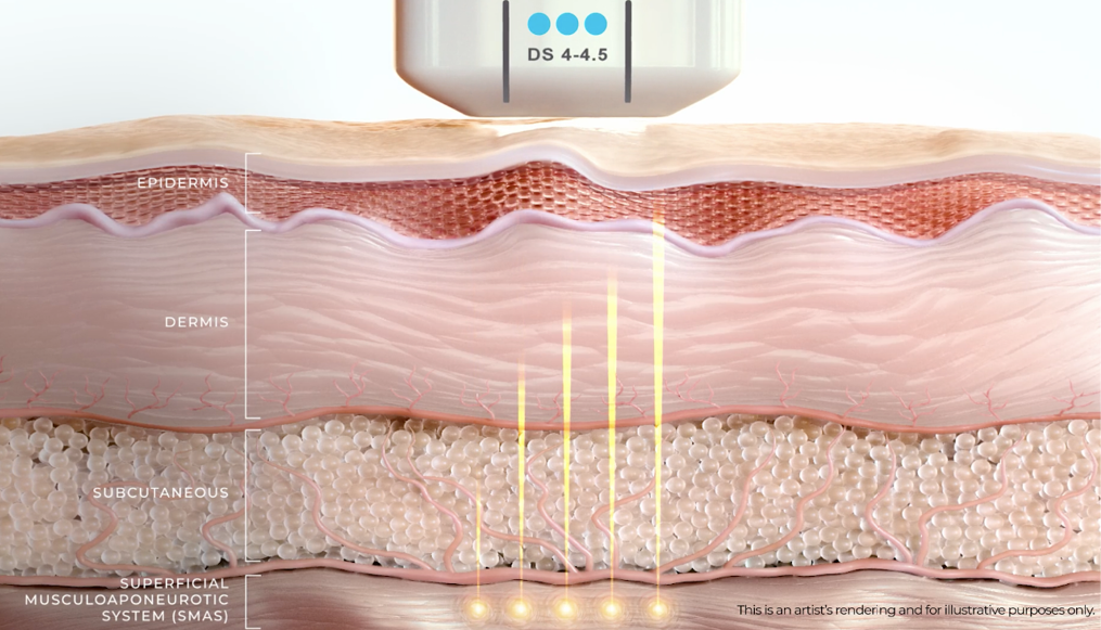 Lifting non invasivo ecografico